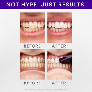 Hismile V34 Whitening Strips