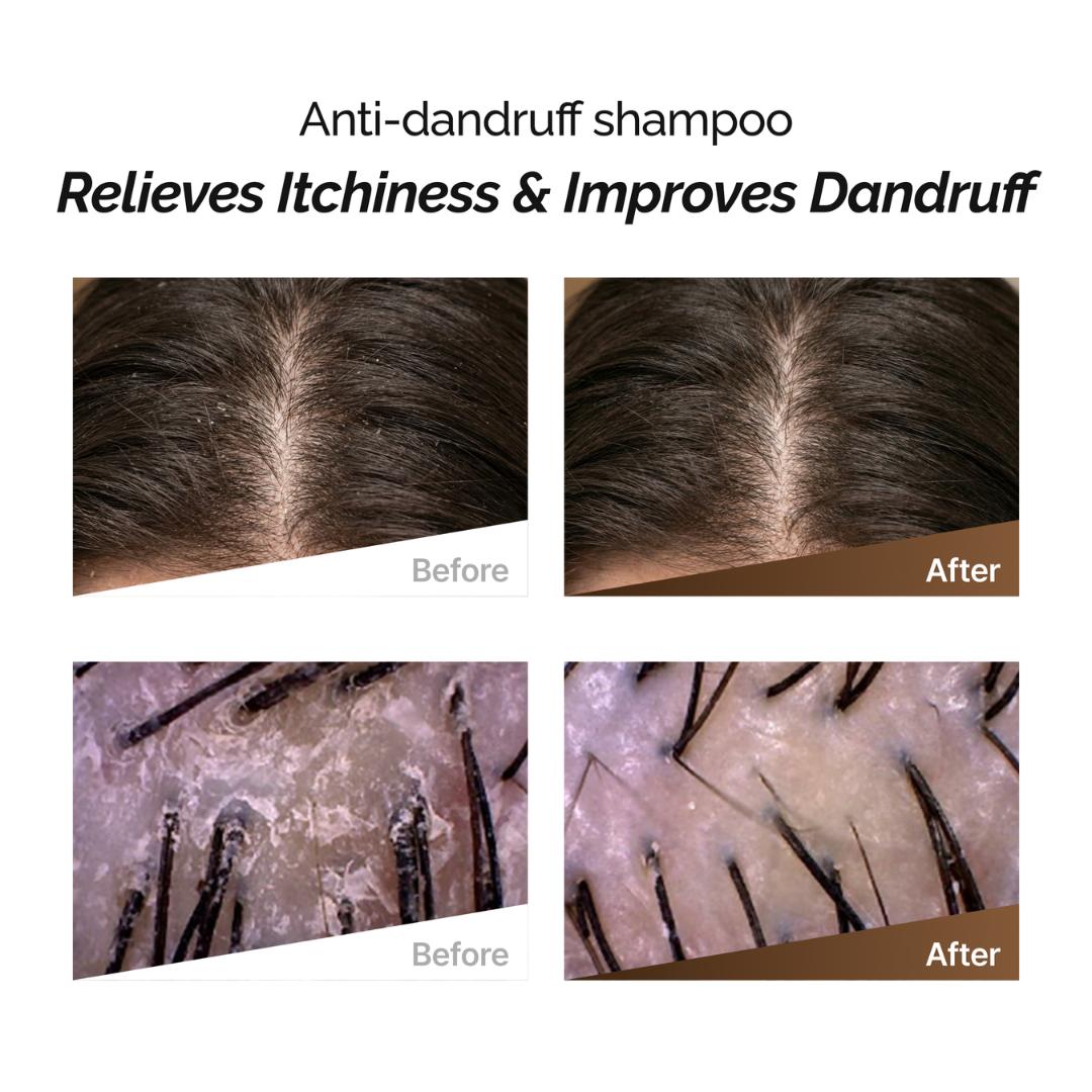 Rootonix Anti Dandruff Sjampó 500ml