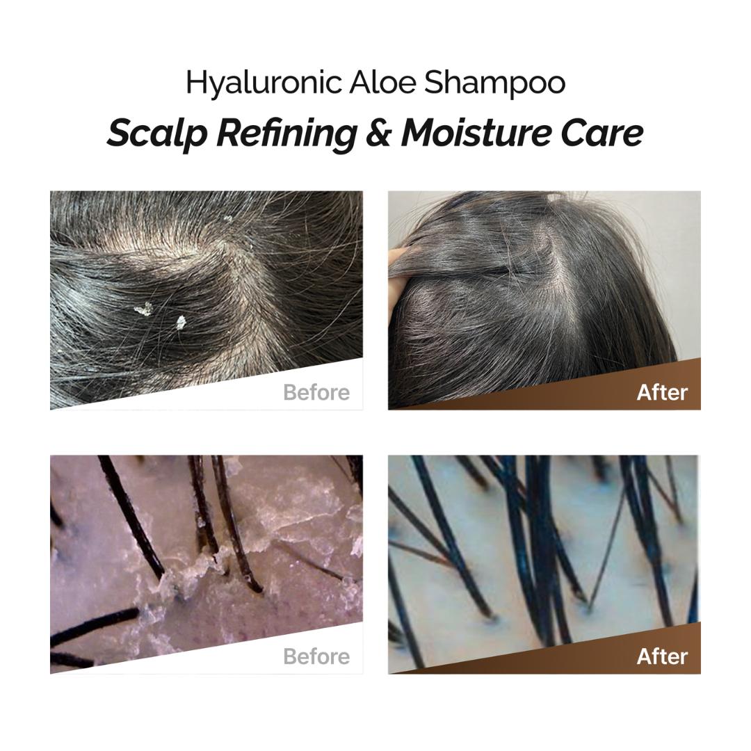 Rootonix Hyaluronic Aloe Dry Scalp Sjampó 500ml